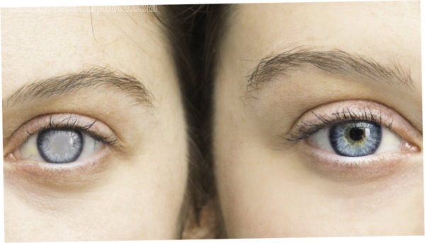 Why Glaucoma Is Increasing Among Young Adults: Causes, Risks, and Early Detection